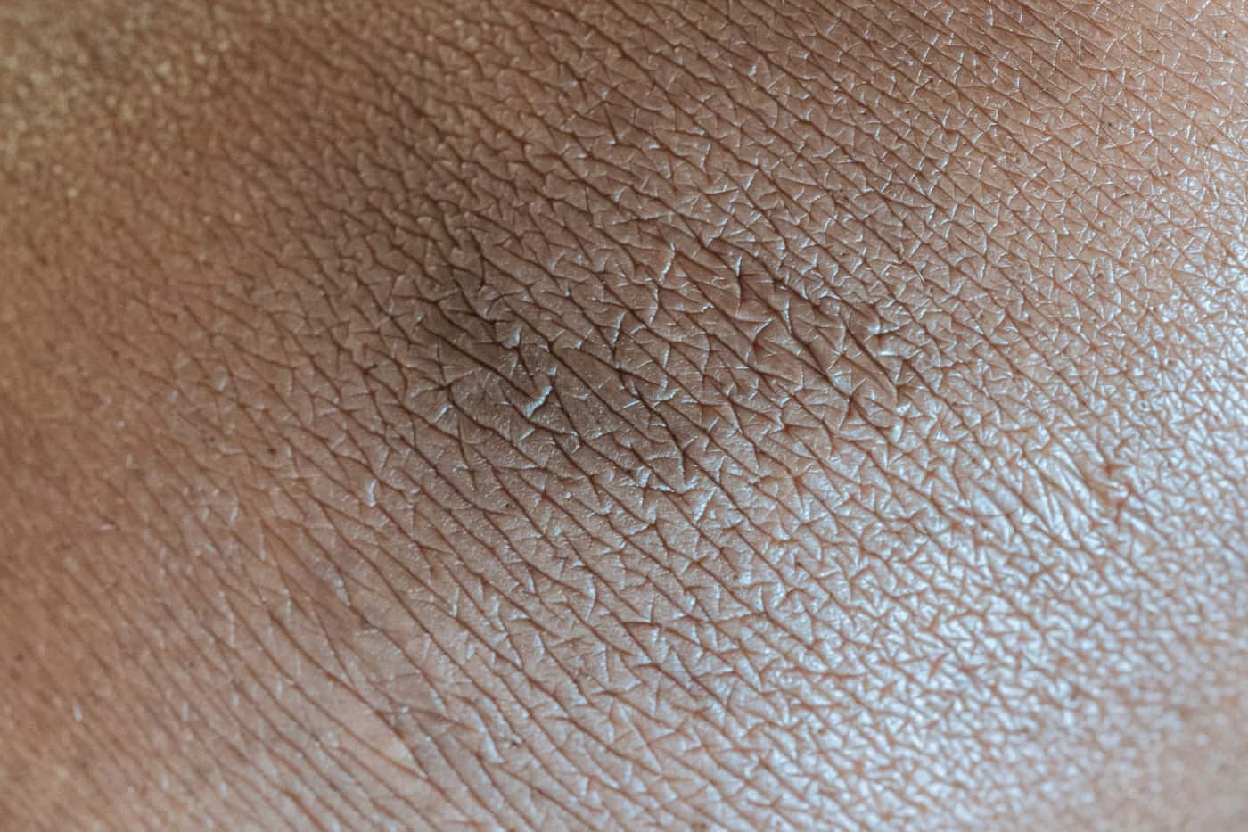 Close-up of dry, textured skin on an arm