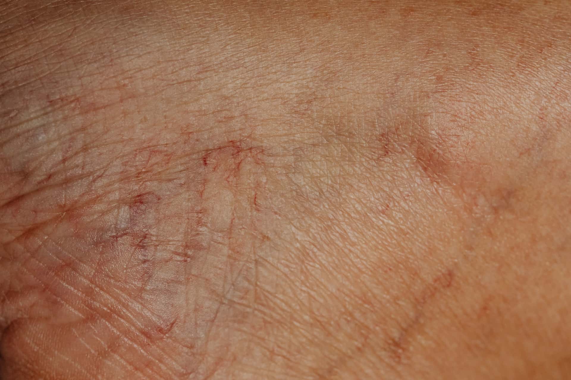 Close detail of uneven skin tone in low directional light